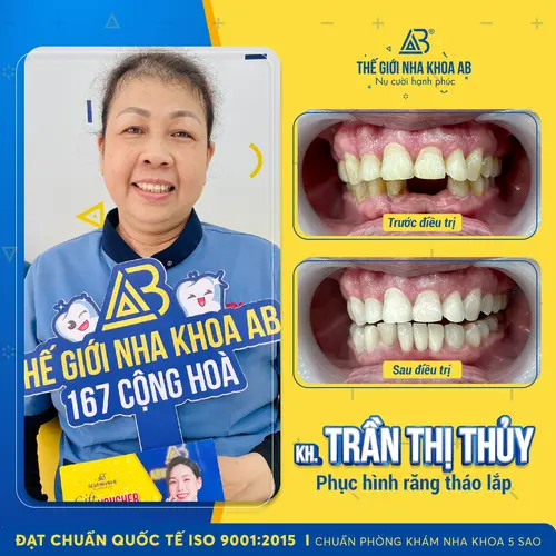 Tình trạng răng trước - sau điều trị của cô Thuỷ