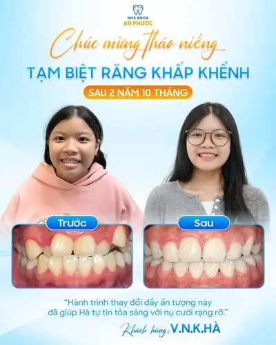 Kết quả sau niềng quá mỹ mãn của Hà tại Nha khoa An Phước