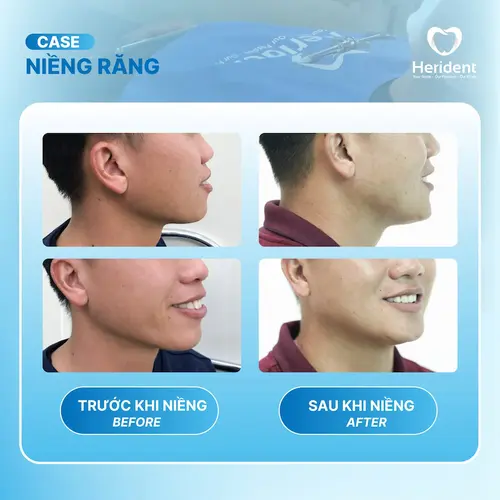 Sau niềng răng tại Herident anh Duy rất hài lòng với kết quả