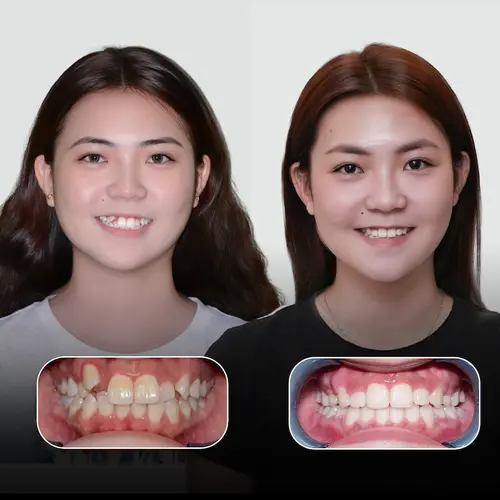 Minh Ngọc tự tin với nụ cười rạng rỡ sau khi niềng răng tại Jet Dentist