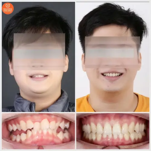 Kết quả sau niềng răng tại Kind Smile làm hài lòng anh Hưng