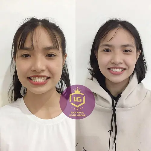 Niềng răng tại Lê Gia Group đã cải thiện rõ rệt về thẩm mỹ cho Lê Thảo