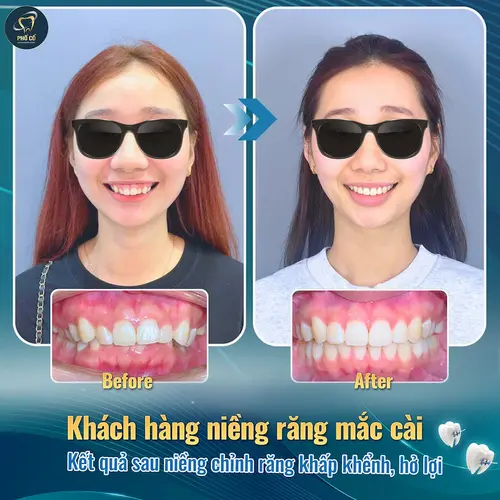 M.H tự tin cười rạng rỡ sau khi tháo mắc cài