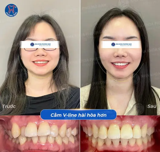 Chị khách hết hô và gương mặt hài hoà cân đối hơn sau niềng