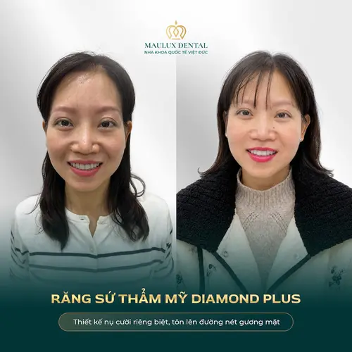 Chị Quỳnh Nga trẻ hóa nhan sắc sau khi làm răng sứ tại Việt Đức