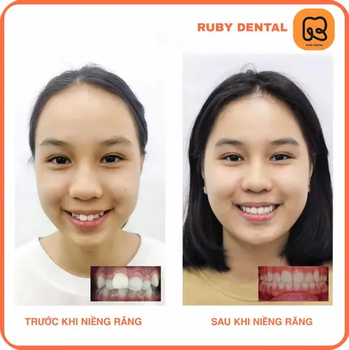 Sự thay đổi thấy rõ sau niềng răng của T.M