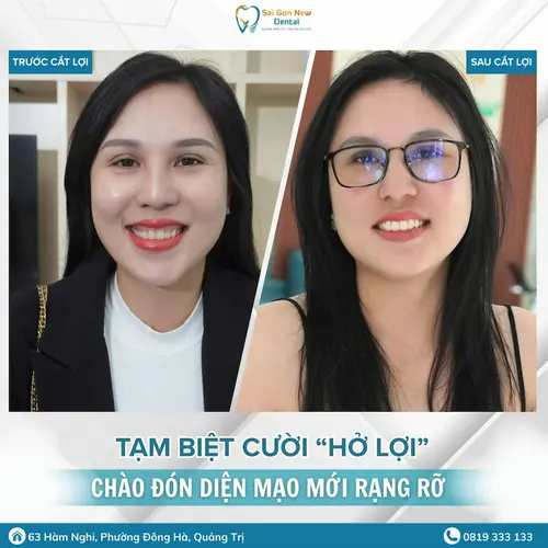 Chị Thúy rạng rỡ với nụ cười mới sau khi cắt lợi thẩm mỹ tại Nha khoa Sài Gòn New