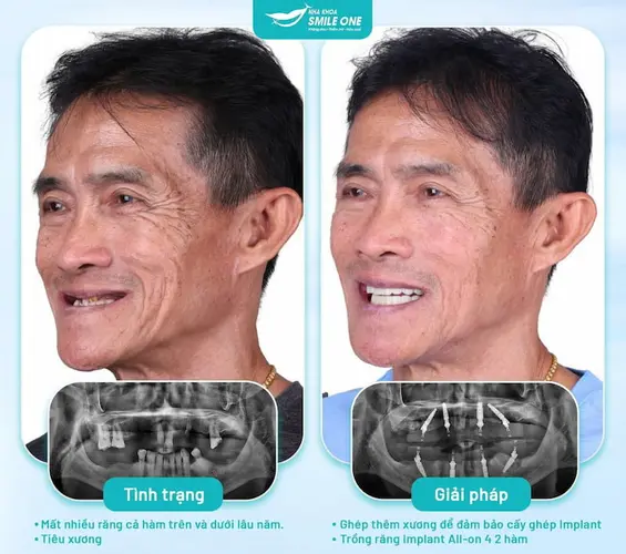 Chú khách có hàm răng mới chắc chắn như răng thật