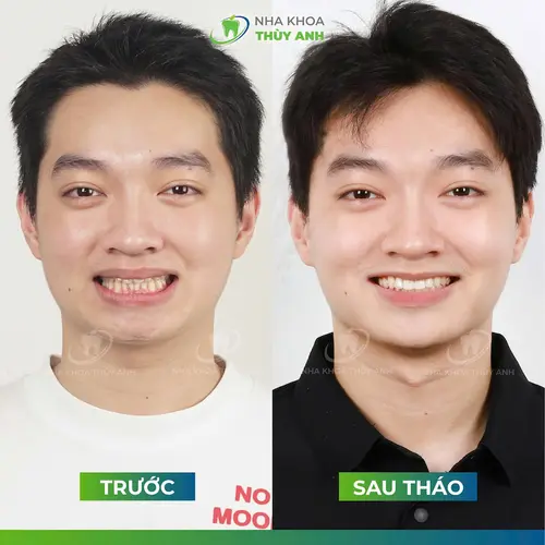 Hoàng Nam lột xác diện mạo sau tháo niềng tại Nha khoa Thùy Anh