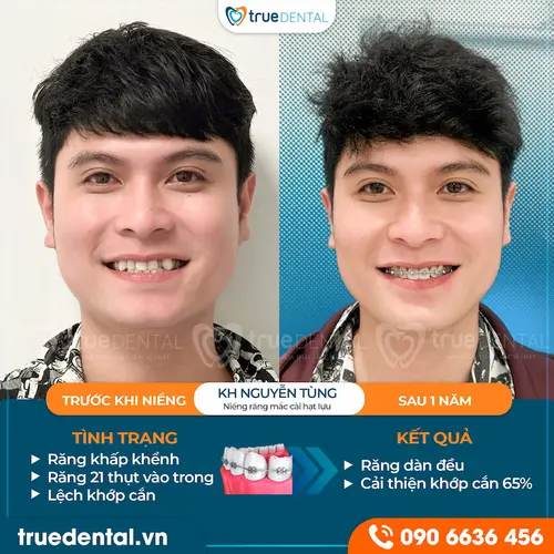 Khách hàng Nguyễn Tùng lột xác diện mạo sau 1 năm niềng răng