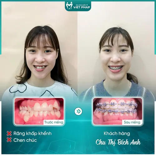 Khách hàng Bích Anh và diện mạo xinh đẹp sau niềng răng tại Úc Châu