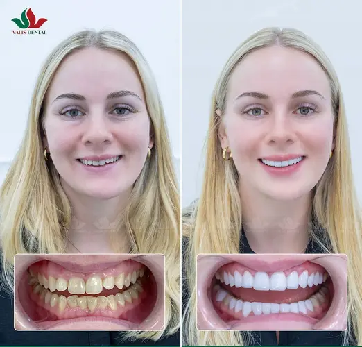 Chị Sophia Andersen rất hài lòng với kết quả phục hình răng sứ tại Valis Luxury