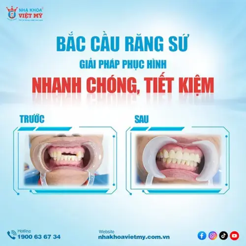 ​Kết quả sau bắc cầu răng sứ của chị Lan​