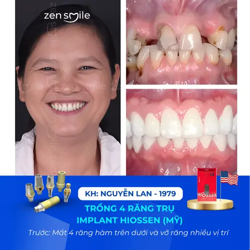 Chị Lan trước và sau khi làm răng tại Zensmile